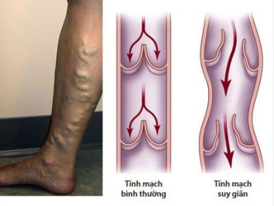 Bệnh giãn tĩnh mạch: Những điều cần biết