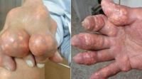 Tìm hiểu về bệnh Gout