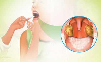 BỆNH BẠCH HẦU: NGUYÊN NHÂN VÀ TRIỆU CHỨNG NHẬN BIẾT