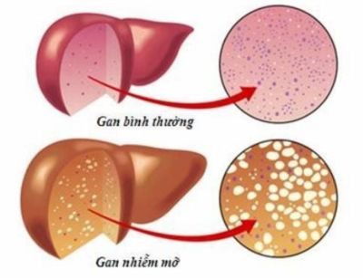 Hiểu đúng về gan nhiễm mỡ